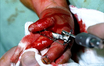 The "Rosenberg" Micro Dermatome, Skin Graft Knife